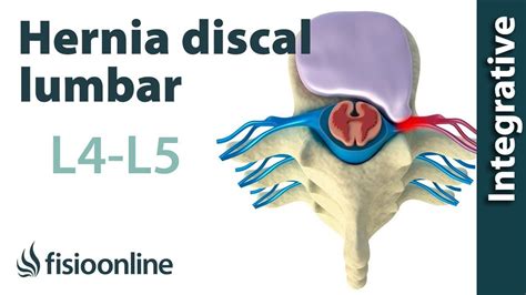 Hernia L4.